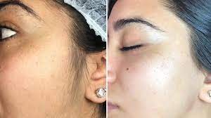 Dermaplaning